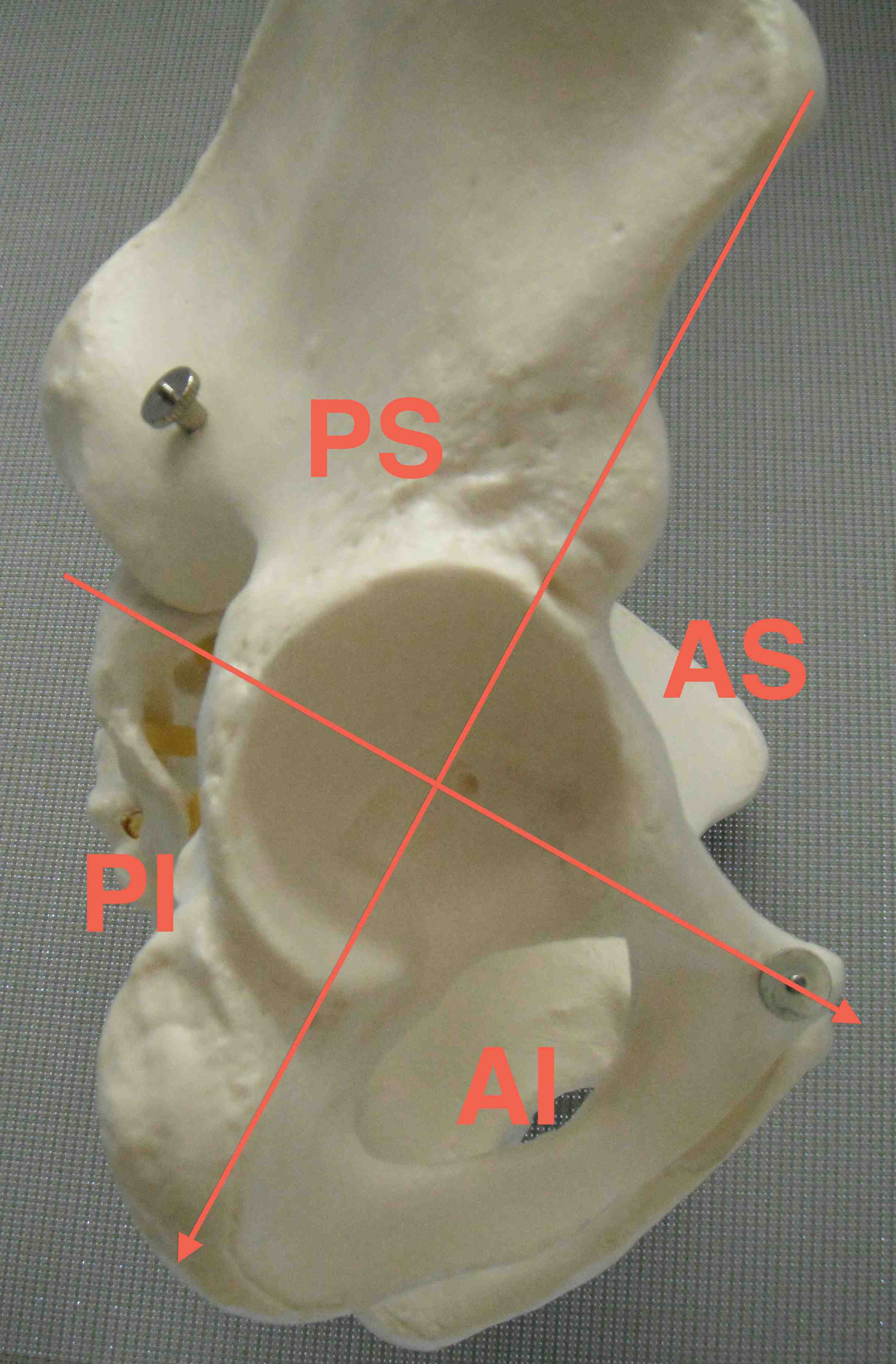 Acetabulum Wasielewski Safe Zones